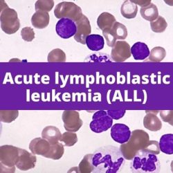 Acute lymphoblastic leukemia hesi case study