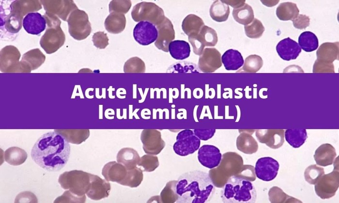 Acute lymphoblastic leukemia hesi case study