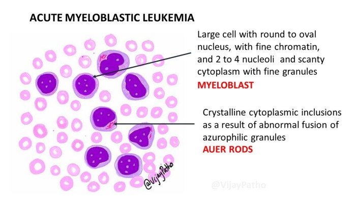 Leukemia case study acute myelogenous